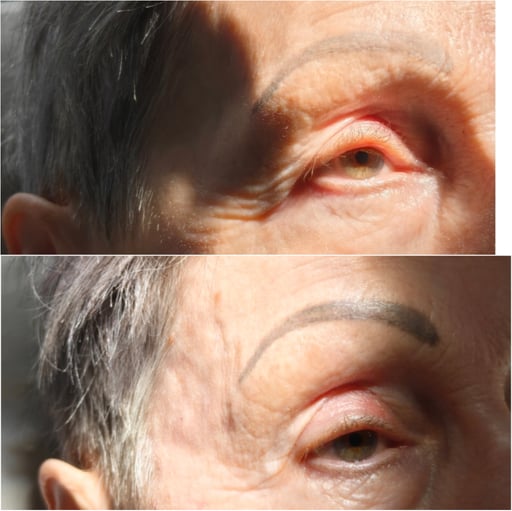 In addition to temple restoration (show here), dermal fillers can be used to enhance the brow bone and forehead fat pads. These areas also lose volume over time, leading to a flatter, more aged appearance. 

By adding volume with fillers, we can create a lifted and rejuvenated look, enhancing your natural facial harmony.

Brow Bone: Enhances the brow's shape and reduces a "sunken" appearance, giving the upper face a more refreshed look.

Forehead Fat Pad: Restores volume to the forehead, reducing lines and creating a smooth, youthful contour.