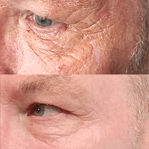 Our acid peels involve professional application of a chemical solution to your skin to remove the top layers. 

The skin then grows back much smoother and with reduced fine lines, hyper-pigmentation and acne scarring. 

This is a wonderful holistic treatment for reducing fine lines, tightening skin, reducing hyperpigmentation and sun spots, encouraging collagen production and improving skin texture.