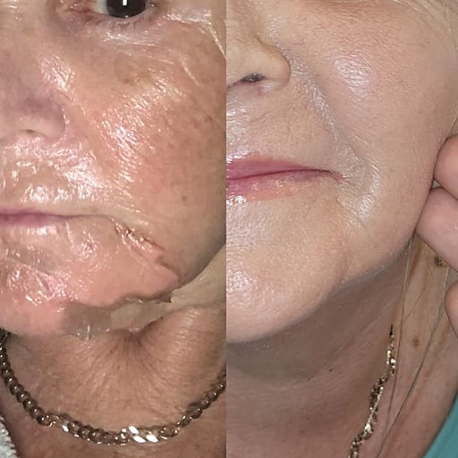 The procedure is carried out by a Medical Professional with specialised, certified training. All our clinics are equipped with Emergency Adrenaline incase of Anaphylaxis. Our treatments have been tweaked and perfected over the years to deliver unique, show-stopping rejuvination. 

Neither of these are a "standard" off-the-shelf peel - the clinical director is extremely passionate about acid peels. 



Factor 50 sun screen is provided to you by the clinic - your skin will require this every day for 2 weeks post-procedure, and you may experience some skin peeling as the dead skin flakes off, which you should not disturb or pick at.