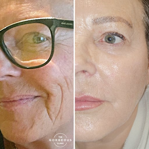 Medium Peel: Skin generally "flakes away" rather than peeling away 

Deep peel: Skin 'ribbons' away from around day 4 to 10.

Skin may be red and a little inflamed, and you may look a little swollen depending on how your skin reacts although this is rare.

You'll need to sleep on a clean pillow case, and avoid touching your face. 