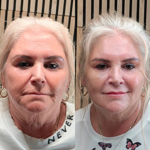 Ready to look fresher, more lifted, and more like yourself again — without surgery?

Our Non-Surgical Face Lift is a highly advanced full-face rejuvenation treatment designed for clients who want to restore what time has softened, shifted, or hollowed, while still looking completely natural. This is not about looking different. It is about looking beautifully well-kept, well-rested, and subtly turned back.