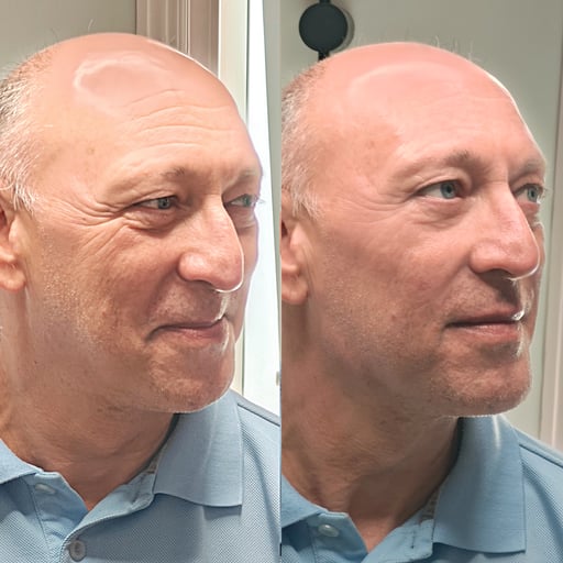 This is one of the highest-value treatments we offer.

Because it combines advanced full-face B-tox with premium dermal filler in one bespoke session, clients often save significantly compared with booking each area individually. 

The overall investment depends on the amount of product required, but the treatment represents outstanding value for the level of artistry, time, and full-face transformation involved.
