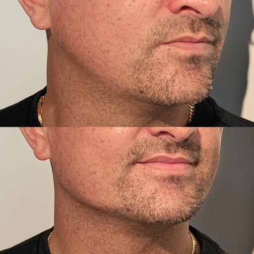 As Radiesse© is non-reversible, it is only offered following a detailed consultation and careful assessment. This ensures the treatment is appropriate for your anatomy, goals, and long-term expectations.

Our clinicians use advanced techniques to place Radiesse© precisely and conservatively, prioritising balance and safety. When selected correctly, it is one of the most effective long-lasting contouring treatments available.