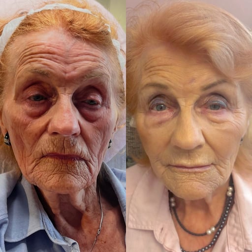 You will still look like yourself — just fresher, lifted, and more refined.

We specialise in natural but noticeable rejuvenation. You will never leave looking heavy, overfilled, or obviously “done”. The goal is always to restore harmony, soften signs of ageing, and bring back support where it has been lost, while keeping your expression and character beautifully intact.

Optimal results are typically seen around 4 weeks after treatment, once the B-tox has fully taken effect and the dermal filler has settled and integrated.

In many areas of the face, we observe dermal filler lasting well over 2 years, depending on placement and individual metabolism.